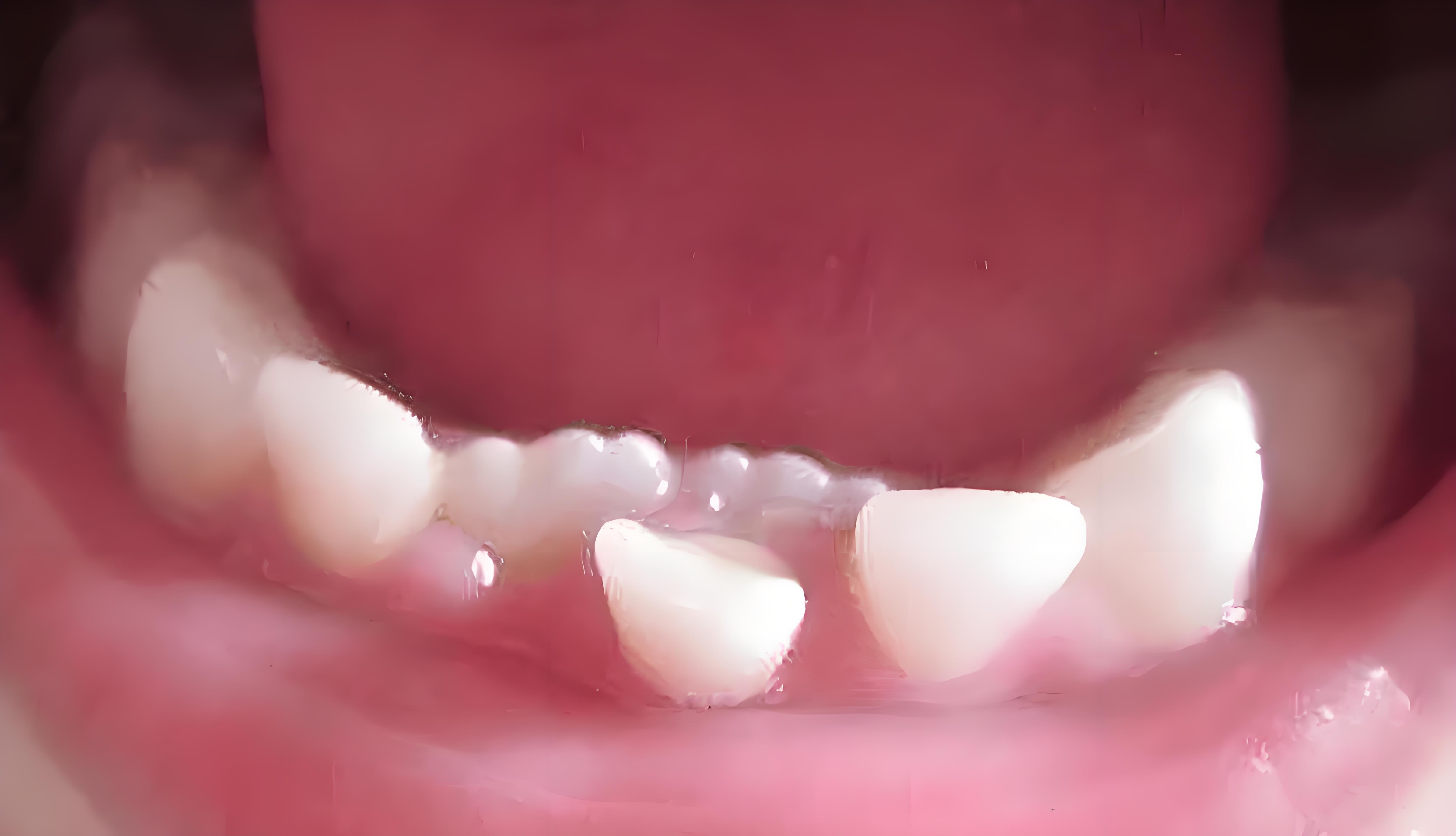 牙齒畸形